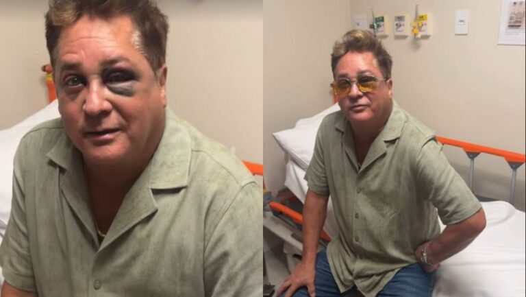 cantor-leonardo-sofre-acidente-e-aparece-com-olho-roxo