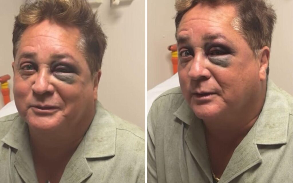 Pescaria no Pantanal terminou com Leonardo com olho roxo e cantor brinca: “Tá bonito, não?”